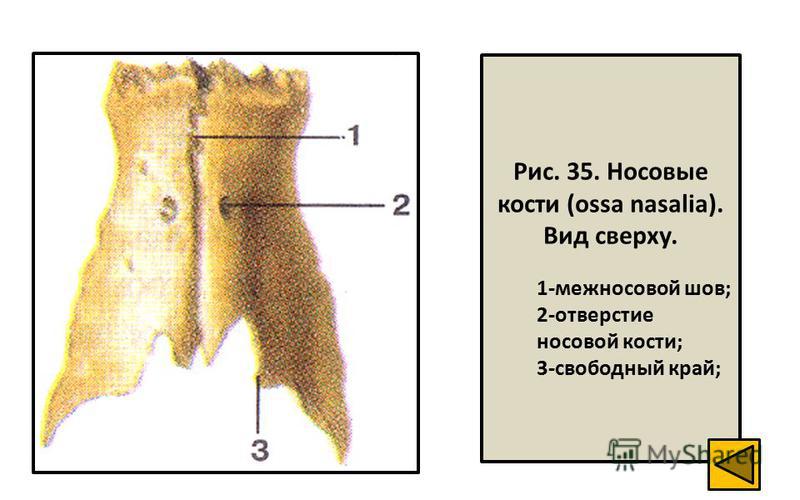 Рис. 35. Носовые кости (ossa nasalia). Вид сверху. 1-межносовой шов; 2-отверстие носовой кости; 3-свободный край;