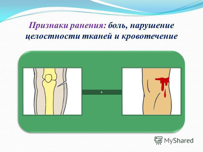Признаки ранения: боль, нарушение целостности тканей и кровотечение