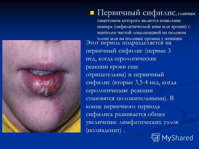 Сифилис Последняя Стадия Фото Сифилис Последняя Стадия Фото