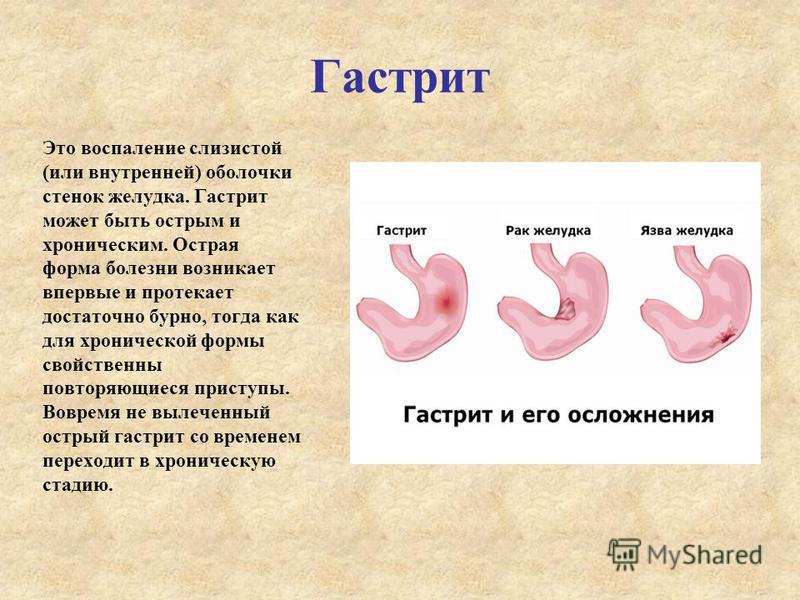 Гастрит и всё что с ним связанное Гастрит и всё что с ним связанное