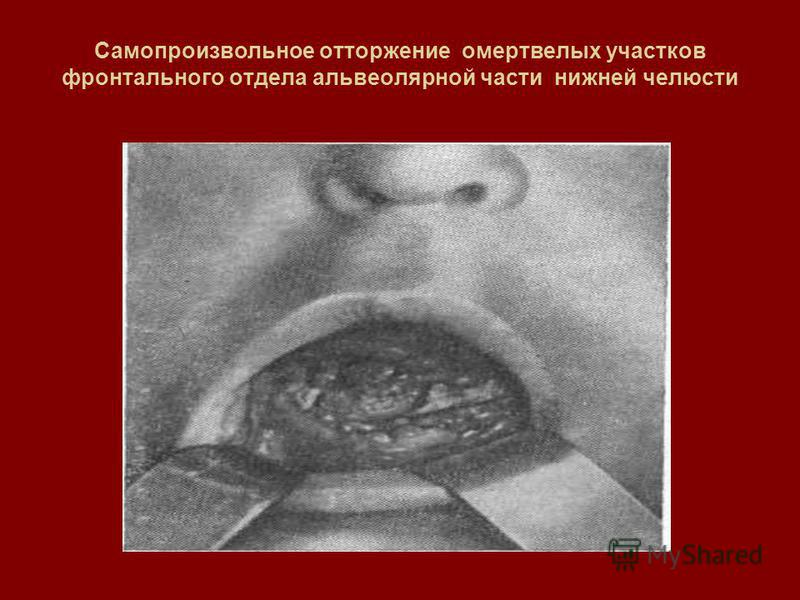 Реферат по теме Травматический остеомиелит нижней челюсти справа,очаговый, без консолидации Реферат по теме Травматический остеомиелит нижней челюсти справа,очаговый, без консолидации