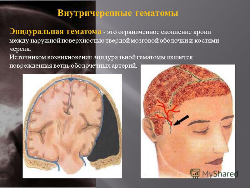 Как лечить гематому головы в домашних условиях Как лечить гематому головы в домашних условиях