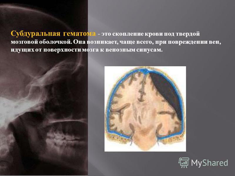 Что такое гематом сустава Что такое гематом сустава