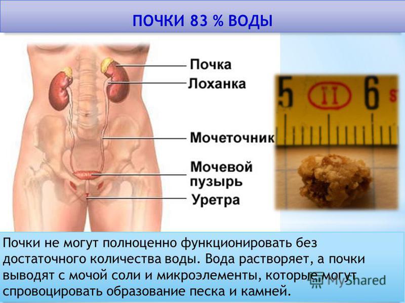Камни в почках как лечить и чем 19