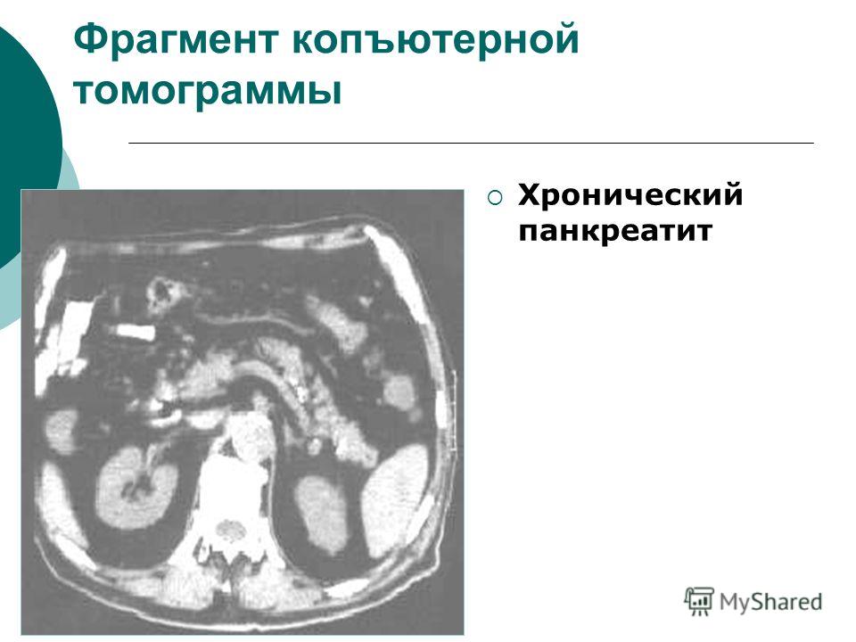 Фрагмент копъютерной томограммы Хронический панкреатит