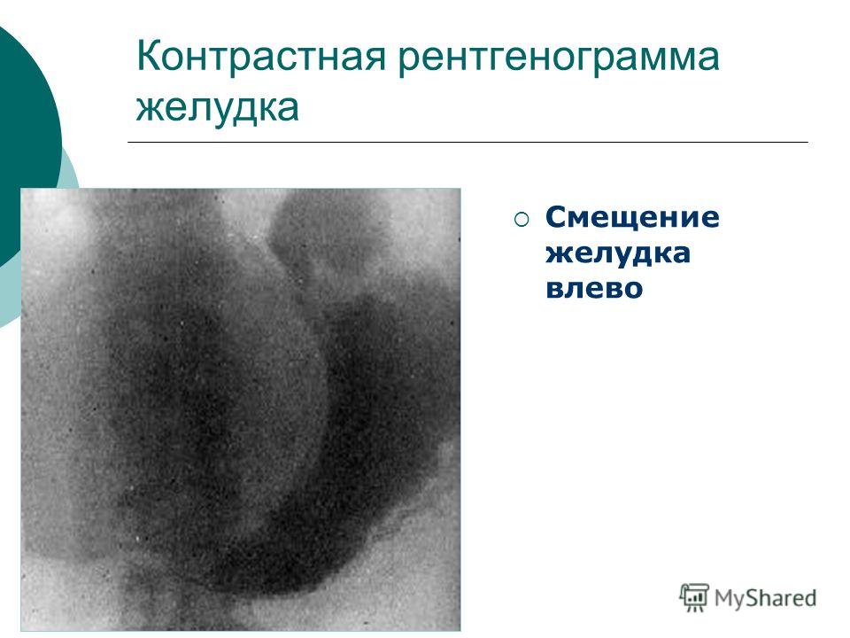 Контрастная рентгенограмма желудка Смещение желудка влево