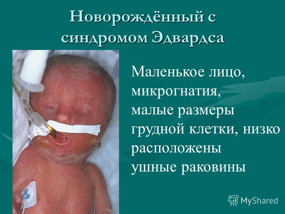 Новорождённый с синдромом Эдвардса Маленькое лицо, микрогнатия, малые размеры грудной клетки, низко расположены ушные раковины