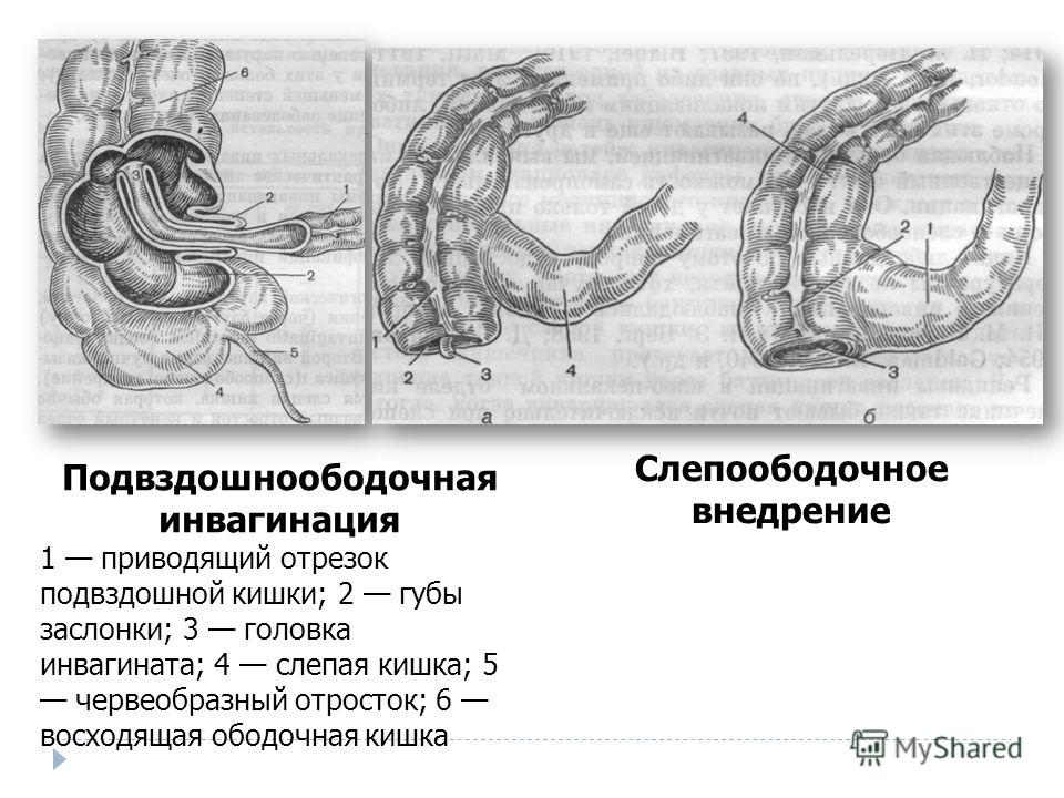 Слепая Кишка Диета