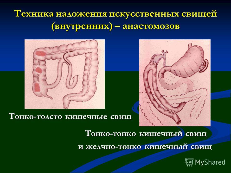 Принцип защиты кожи вокруг свища Принцип защиты кожи вокруг свища