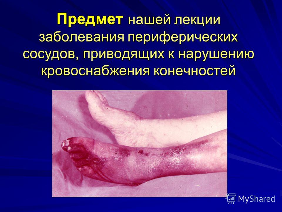 Периферический рисунок обеднен Пороки сердца врождённые