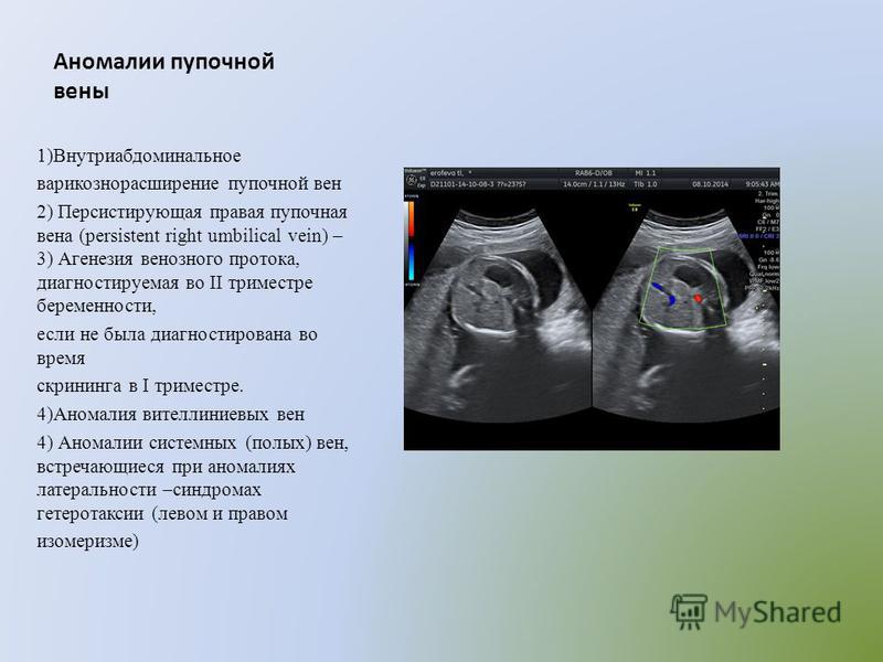 Комплекс упражнений при варикозном расширении вен нижних конечностей