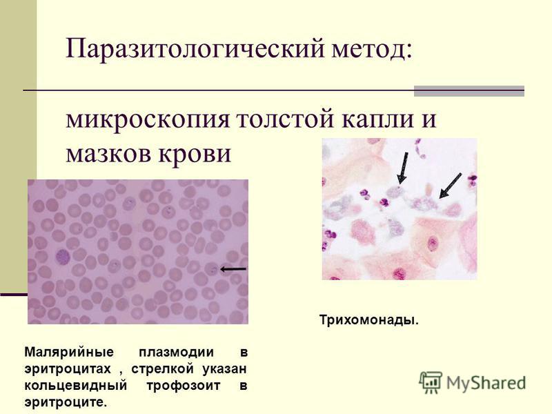 Hematuria (sânge în urină) | ROmedic
