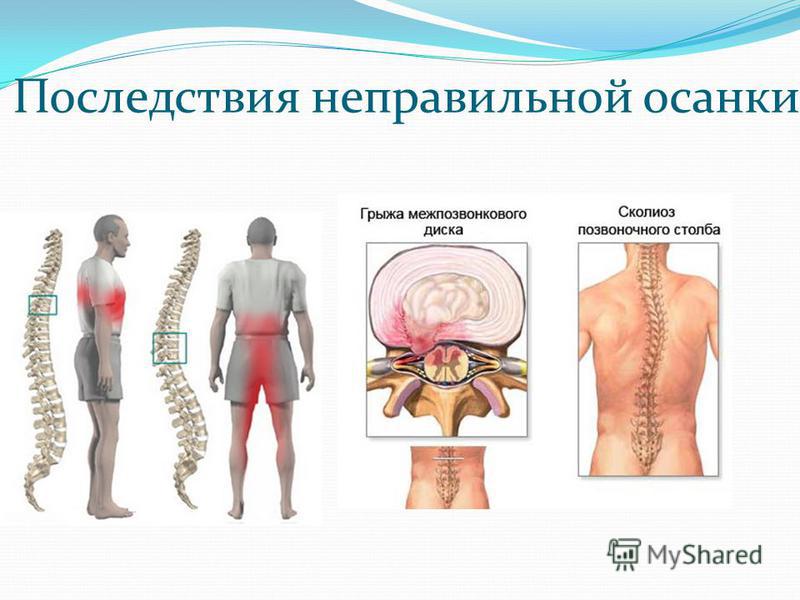 Ортопедические товары реклинатор