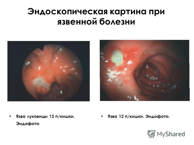 Катаральный гастрит язва луковицы 12 Катаральный гастрит язва луковицы 12