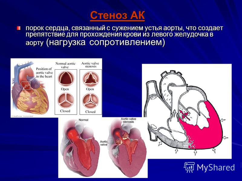 С чем связан стеноз С чем связан стеноз