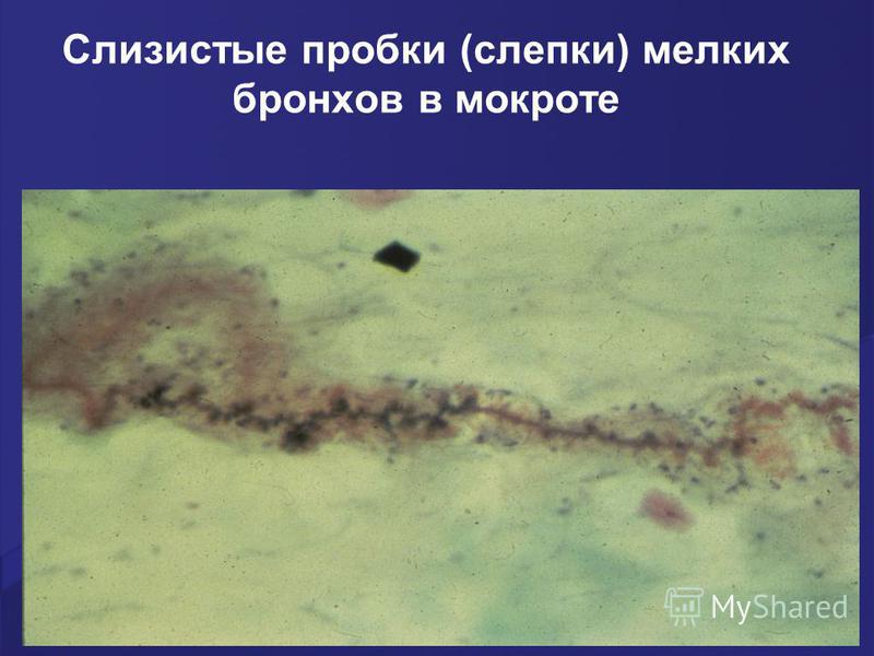 Как выглядит мокрота при раке