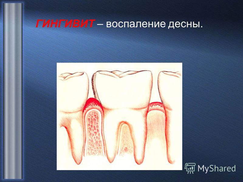 Ноют и воспаляются десна Ноют и воспаляются десна