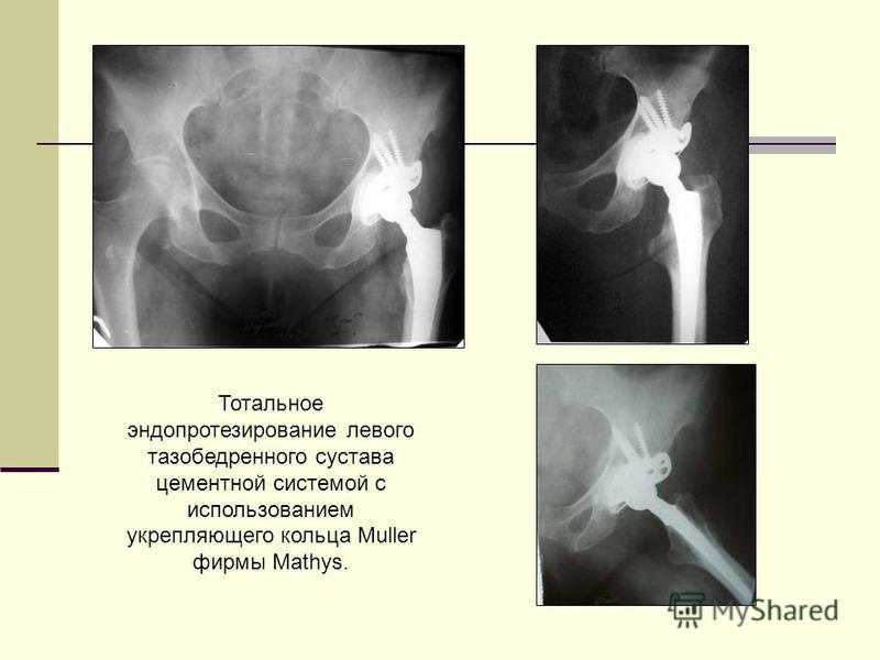Тотальный цементный эндопротез тазобедренного сустава Тотальный цементный эндопротез тазобедренного сустава