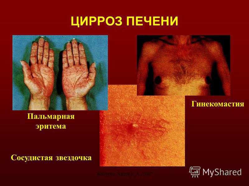Сосудистая эритема кожи Сосудистая эритема кожи
