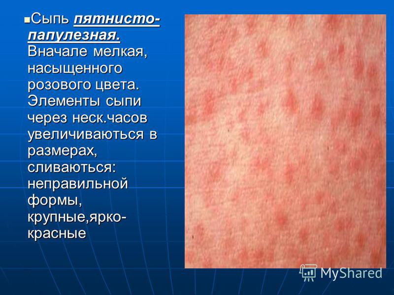 Кожная сыпь у ребенка что это Кожная сыпь у ребенка что это