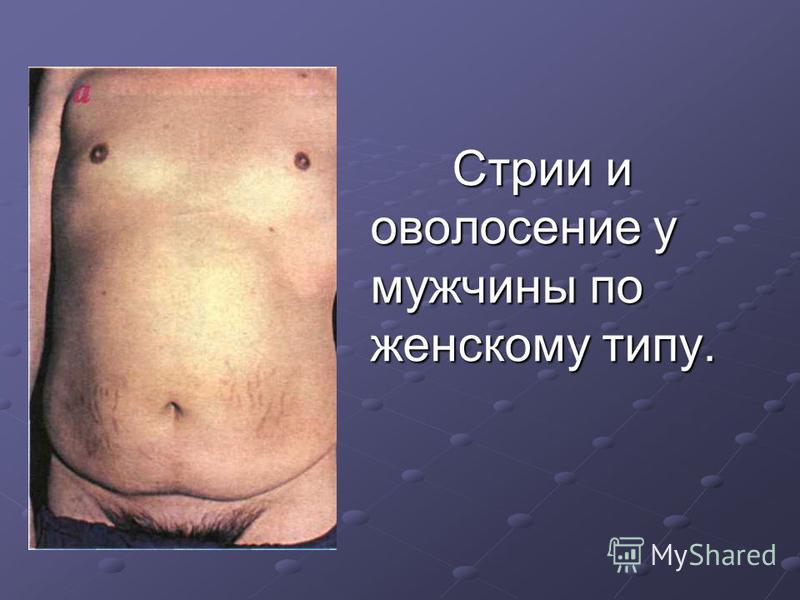 Оволосение лобка по женскому типу Оволосение лобка по женскому типу