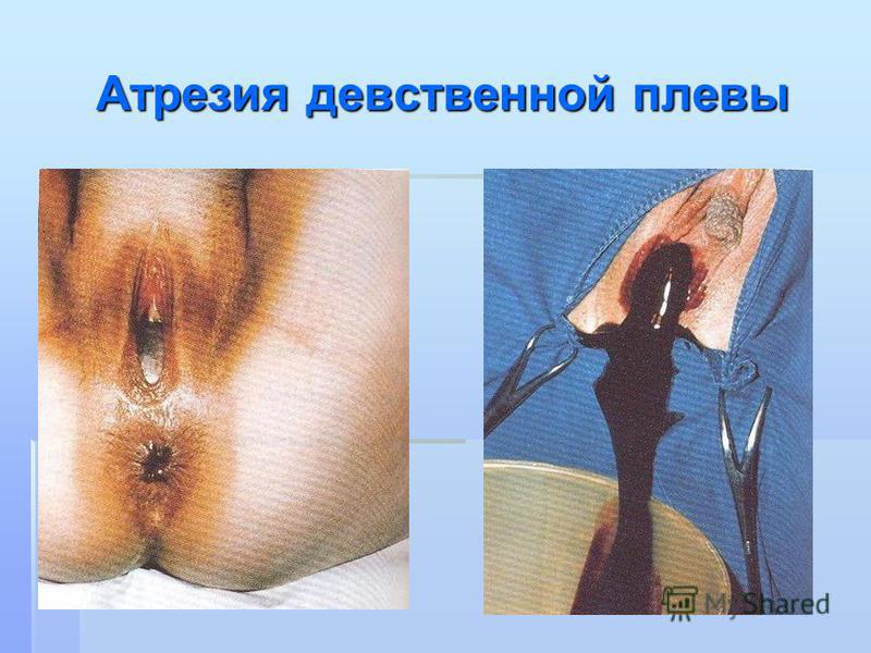 Где находится девственная плева у ребенка фото Где находится девственная плева у ребенка фото