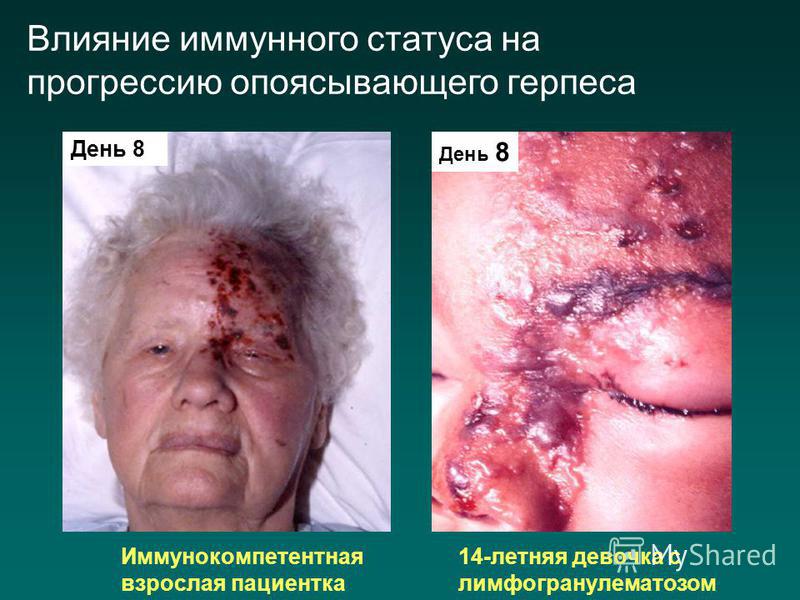 Что за инфекция с сыпью Что за инфекция с сыпью