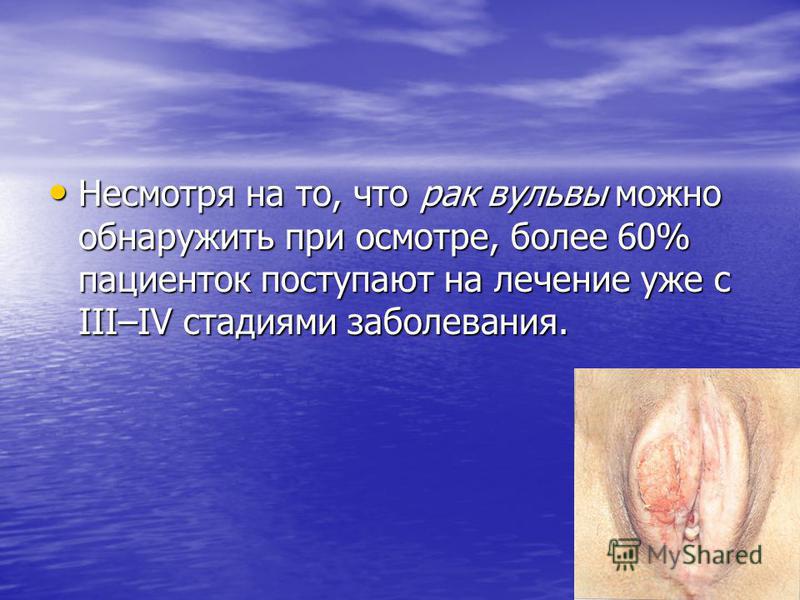 Рак вульвы прогноз 4