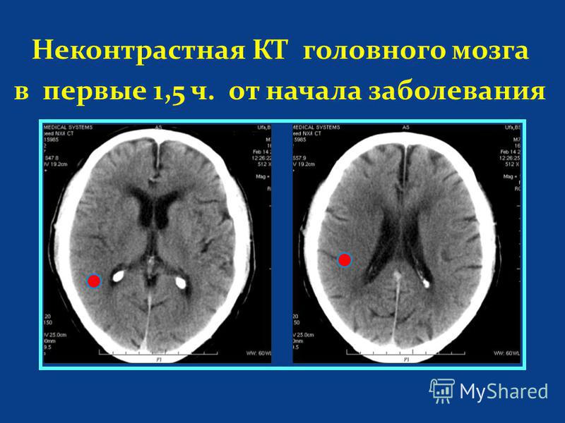 Неконтрастная КТ головного мозга в первые 1,5 ч. от начала заболевания