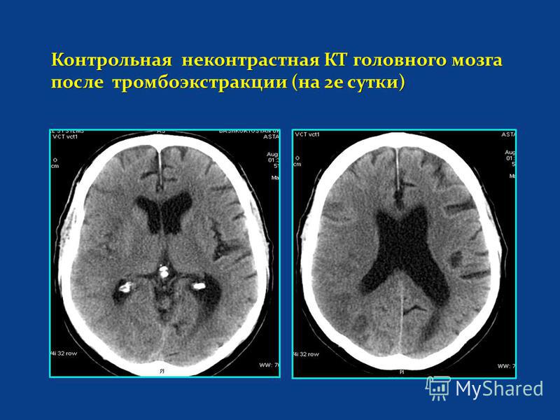 Контрольная неконтрастная КТ головного мозга после тромбоэкстракции (на 2 е сутки)