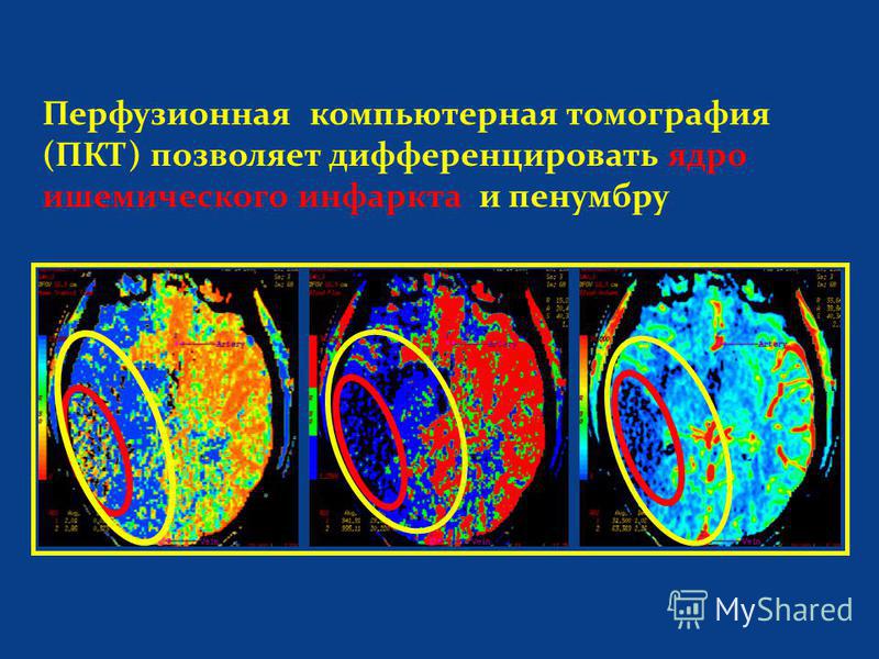 Перфузионная компьютерная томография (ПКТ) позволяет дифференцировать ядро ишемического инфаркта и пенумбру