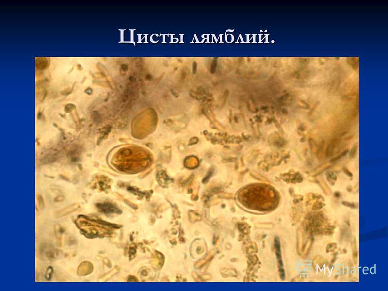 Giardiasis in children: symptoms, signs, diagnosis. Lots of photos