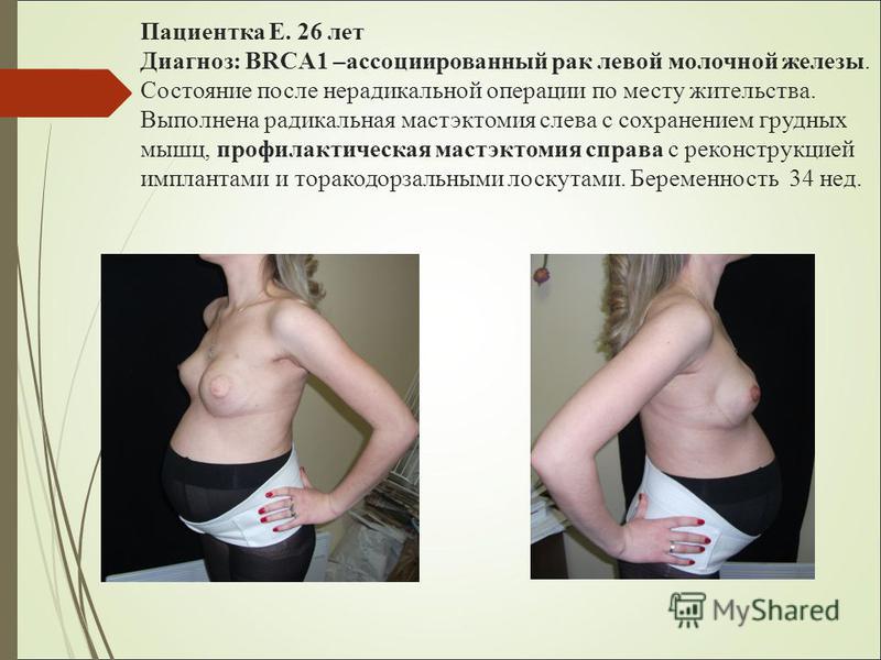 Маммопластика беременность сразу Маммопластика беременность сразу