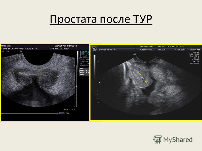 Holep аденоме предстательной железы Holep аденоме предстательной железы