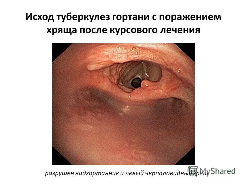 Воспаление хрящи лечение Воспаление хрящи лечение