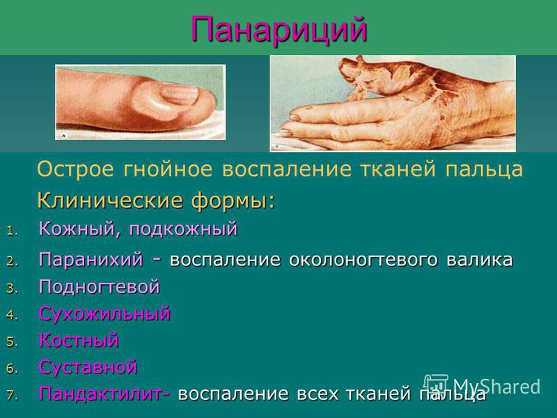 Воспаление тканей около сустава на пальце ноги. Из за чего бывает воспаление сустава большого пальца ноги? Болит большой палец на ноге, опух сустав: причины и лечение Воспаление сустава большого пальца ноги: причины, симптомы, лечение