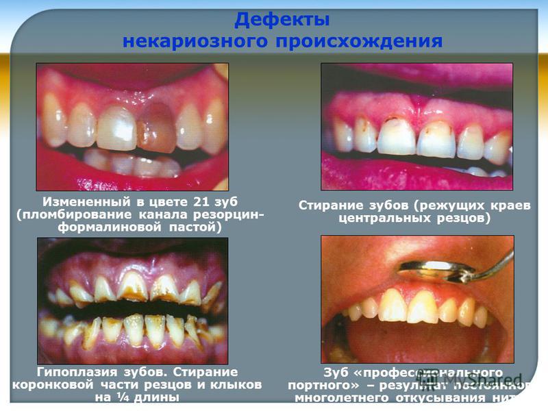 Пломбирование каналов зубов резорцином Пломбирование каналов зубов резорцином