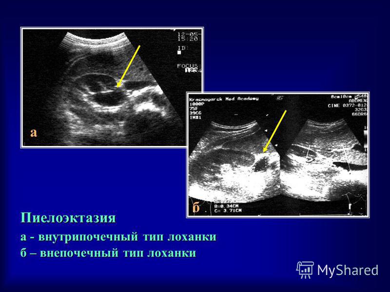 Пиелокаликоэктазия правой почки у беременных 13