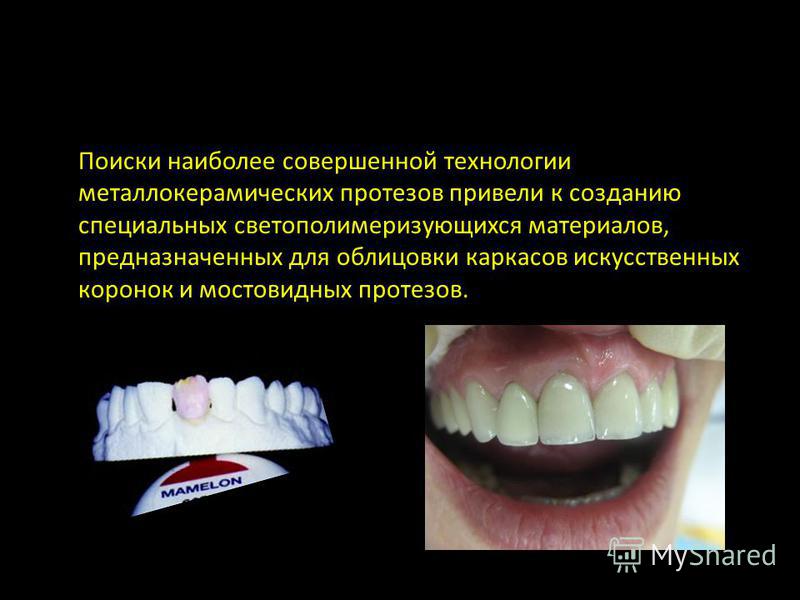 Керамические облицовки для зубов Керамические облицовки для зубов