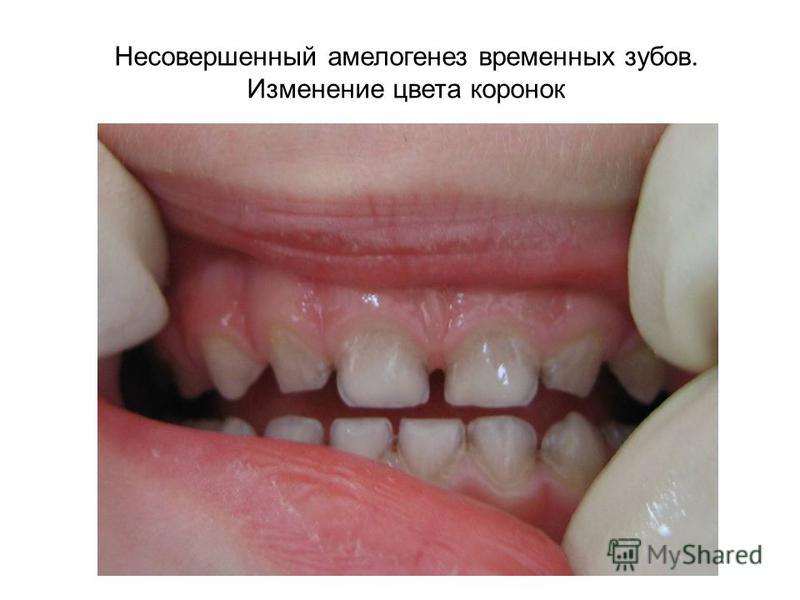Зубы при несовершенном Зубы при несовершенном