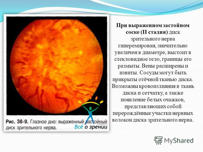 Как лечить застойный диск зрительного нерва Как лечить застойный диск зрительного нерва