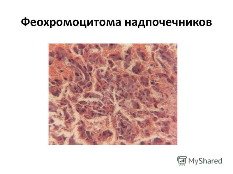 Феохромоцитома надпочечников