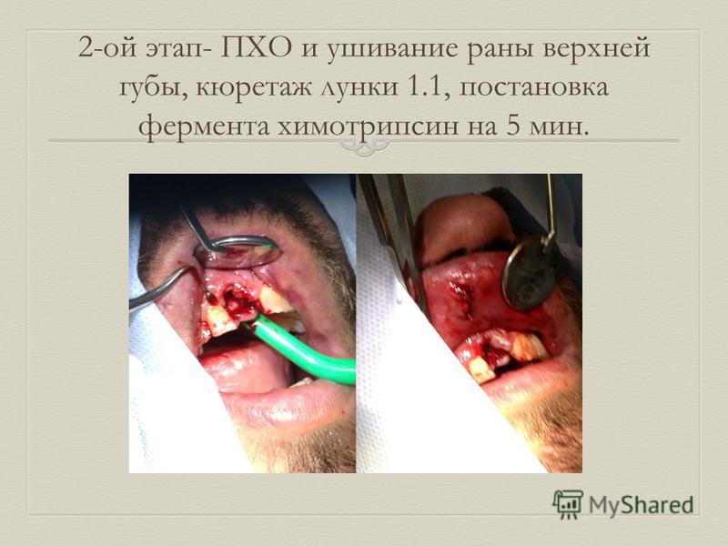 2-ой этап- ПХО и ушивание раны верхней губы, кюретаж лунки 1.1, постановка фермента химотрипсин на 5 мин.