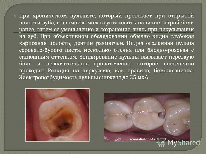 При хроническом пульпите, который протекает при открытой полости зуба, в анамнезе можно установить наличие острой боли ранее, затем ее уменьшение и сохранение лишь при накусывании на зуб. При объективном обследовании обычно видна глубокая кариозная п