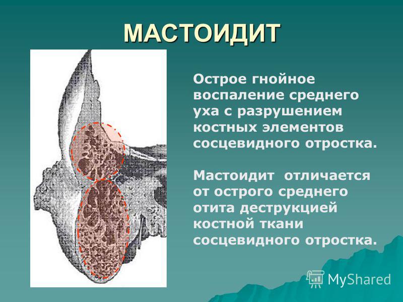 МАСТОИДИТ Острое гнойное воспаление среднего уха с разрушением костных элементов сосцевидного отростка. Мастоидит отличается от острого среднего отита деструкцией костной ткани сосцевидного отростка.