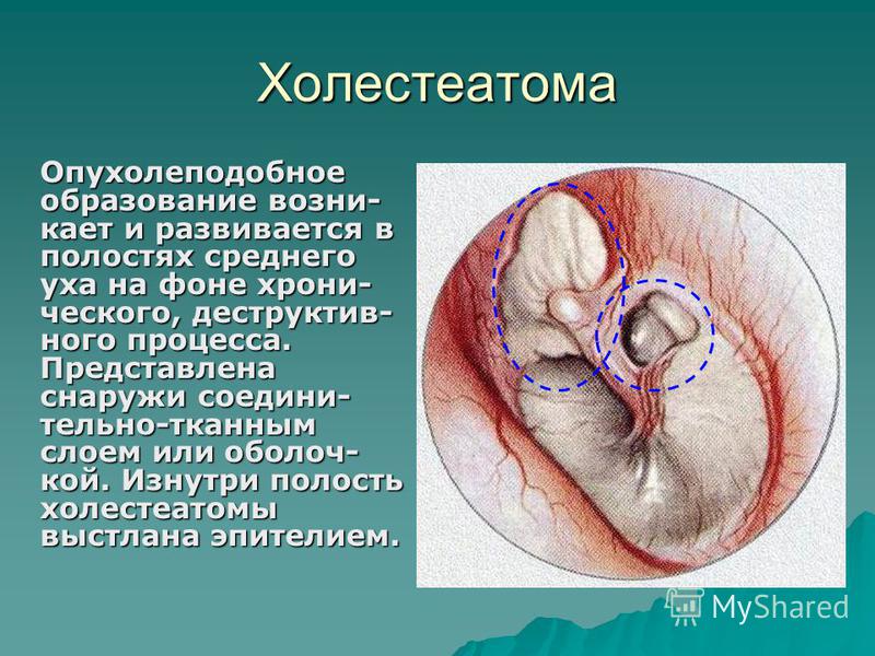 С холестеатомой уха с перфорацией вверх, кольцо синхронизатора jp group и голы видео ростов спартак 30 ноября С холестеатомой уха с перфорацией вверх