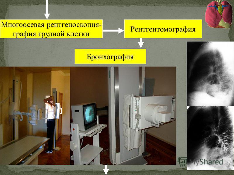 Многоосевая рентгеноскопия- графия грудной клетки Рентгентомография Бронхография