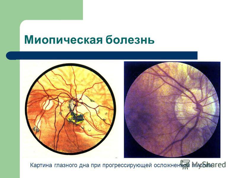Миопическая болезнь Картина глазного дна при прогрессирующей осложненной миопии