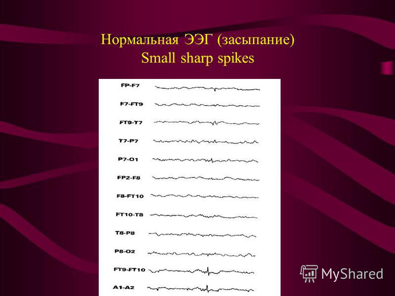Нормальная ЭЭГ (засыпание) Small sharp spikes