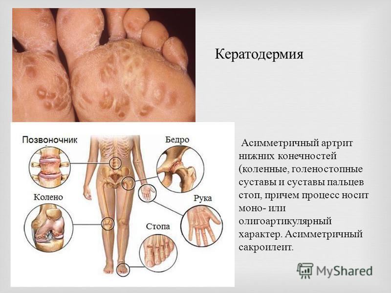 артрит нижних конечностей мкб 10 проблема описанная